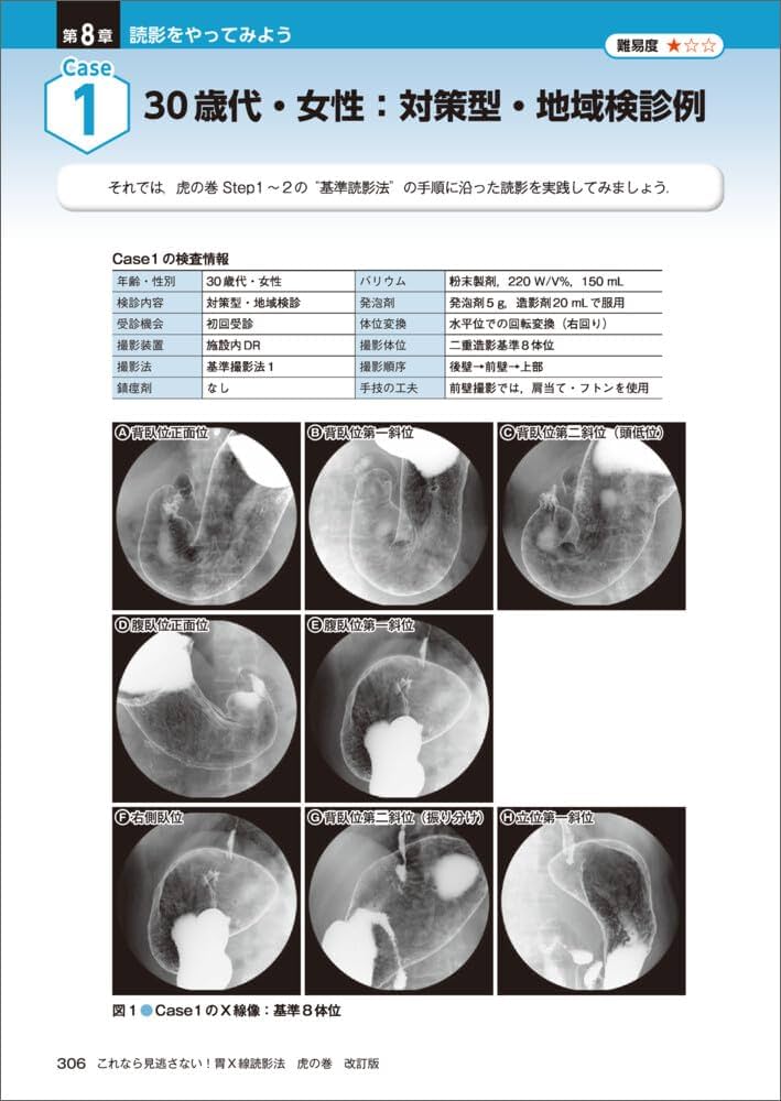 これなら見逃さない！胃X線読影法 虎の巻 改訂版〜シェーマ＋内視鏡像